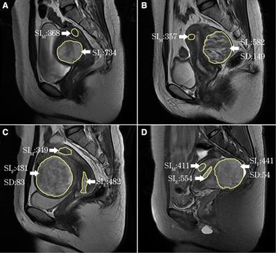 Ultrasound-guided HIFU for uterine fibroids of hyperintense on T2-weighted MR imaging with or without GnRH-analogue-pretreated: A propensity score matched cohort study